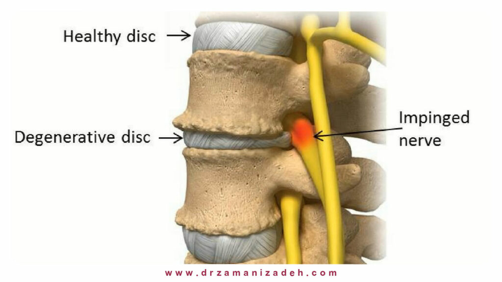 بیماری دیسک زوال یافته (Degenerative disc disease)