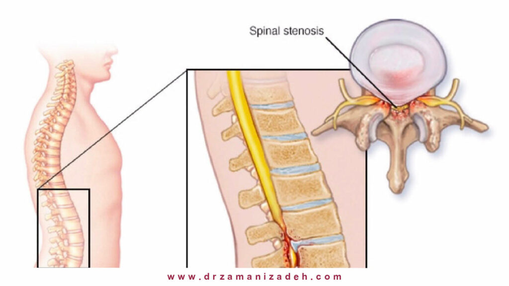 تنگی کانال نخاعی (Spinal stenosis)