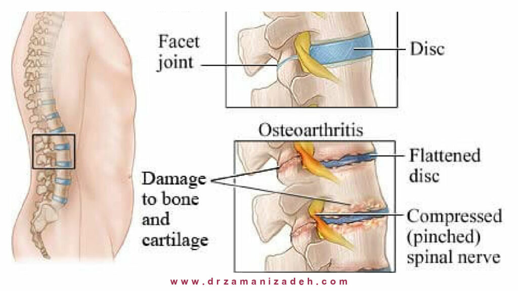 آرتروز ستون فقرات (Spinal osteoarthritis)